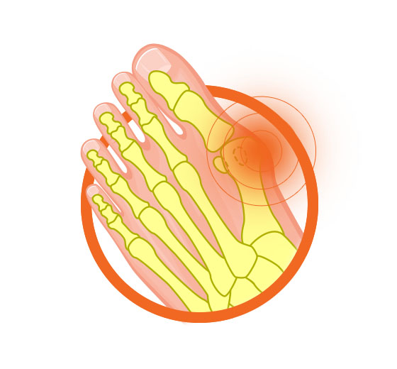 Bunions Foot Diagram Image