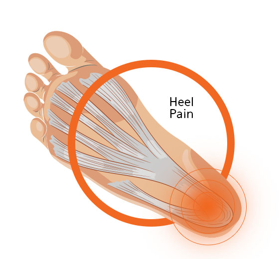 Heel Pain Foot Diagram