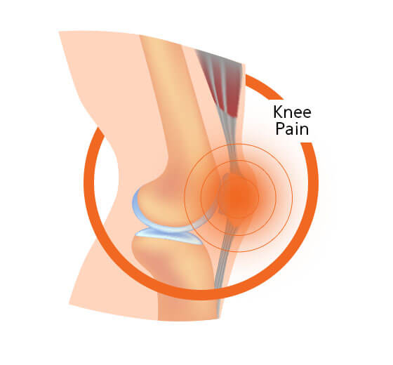 Knee Pain Diagram Image